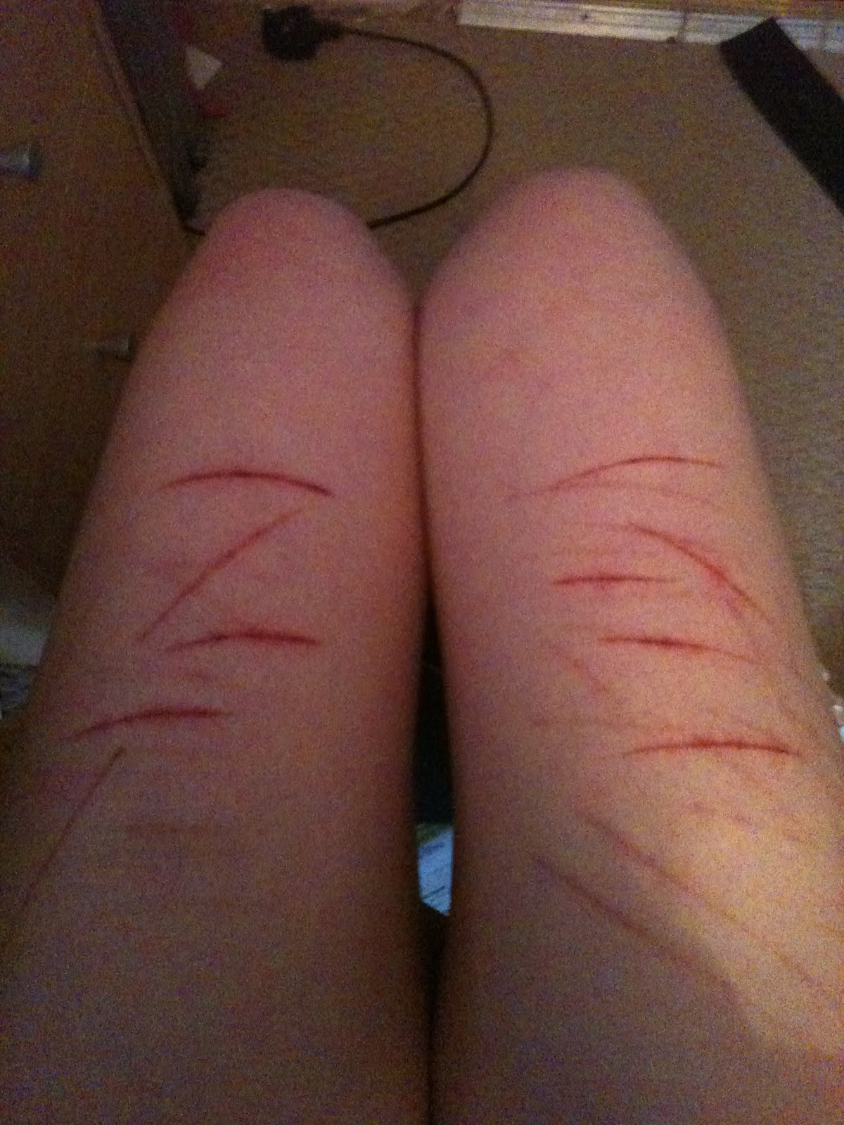 cuts on arms self harm